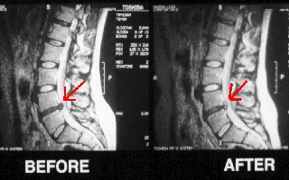 before-after-MRI
